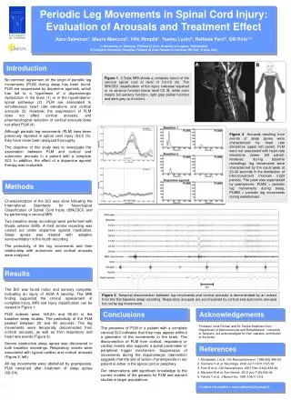 Periodic Leg Movements in Spinal Cord Injury: Evaluation of Arousals and Treatment Effect