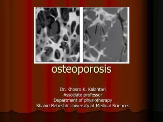 osteoporosis