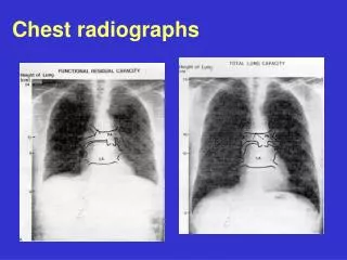 Chest radiographs
