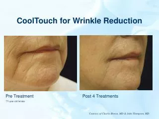 CoolTouch for Wrinkle Reduction