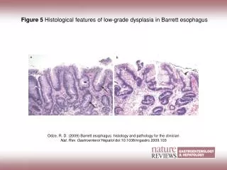 Figure 5 Histological features of low-grade dysplasia in Barrett esophagus