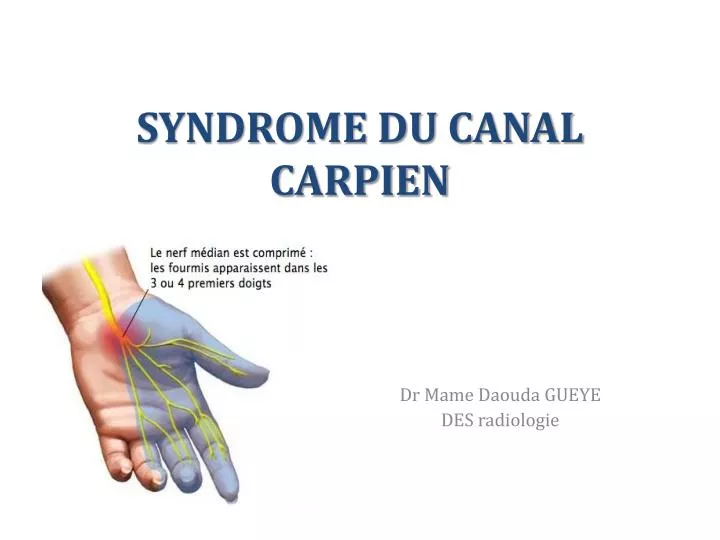 syndrome du canal carpien