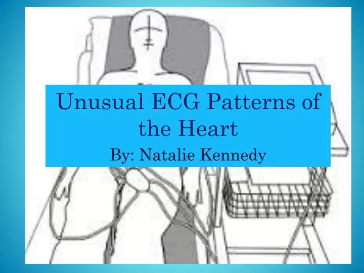 unusual ecg patterns of the heart