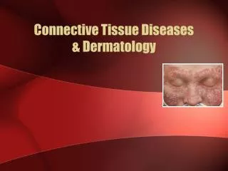 Connective Tissue Diseases &amp; Dermatology