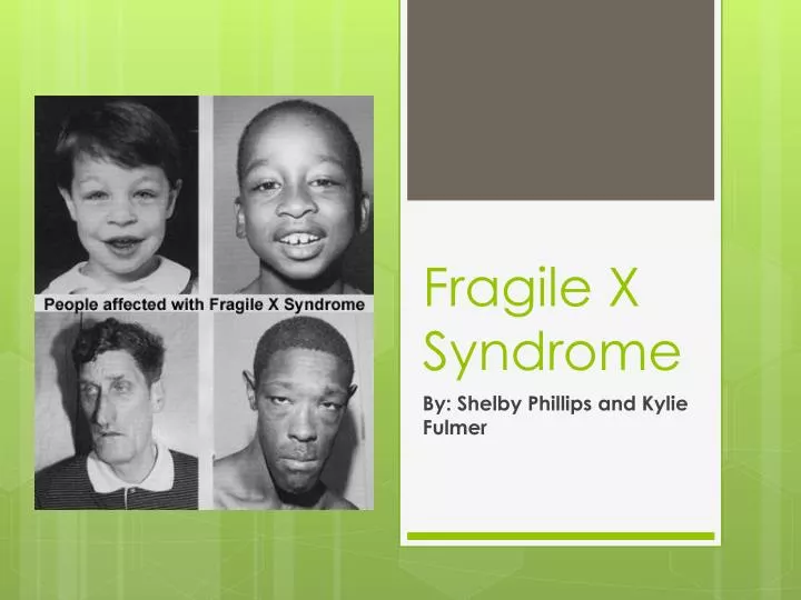 fragile x syndrome