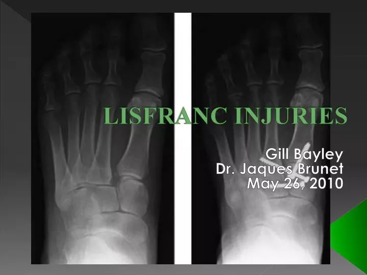 lisfranc injuries