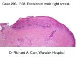 Excision of Mole from Right Breast: Summary of Histopathological Findings at Warwick Hospital - slide 1