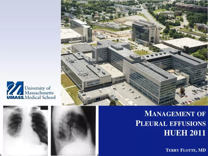 management of pleural effusions hueh 2011 terry flotte md