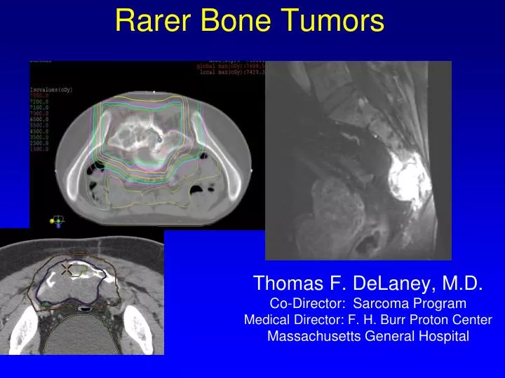rarer bone tumors
