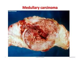 Medullary carcinoma