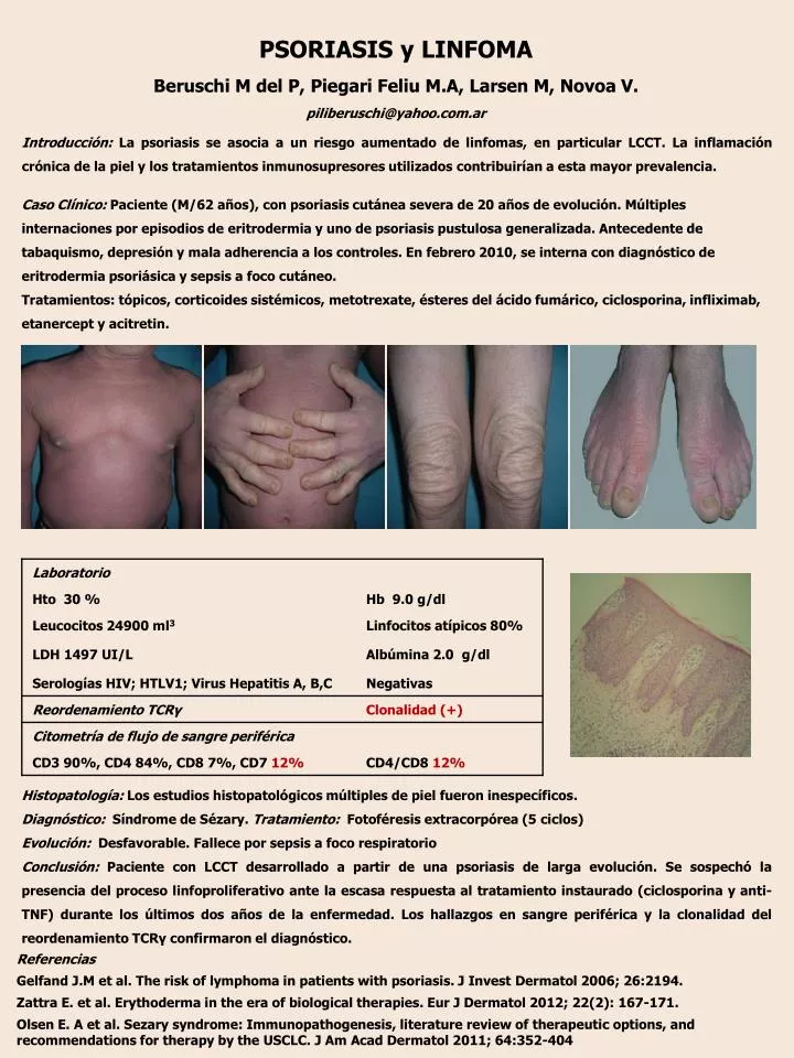 psoriasis y linfoma beruschi m del p piegari feliu m a larsen m novoa v piliberuschi@yahoo com ar