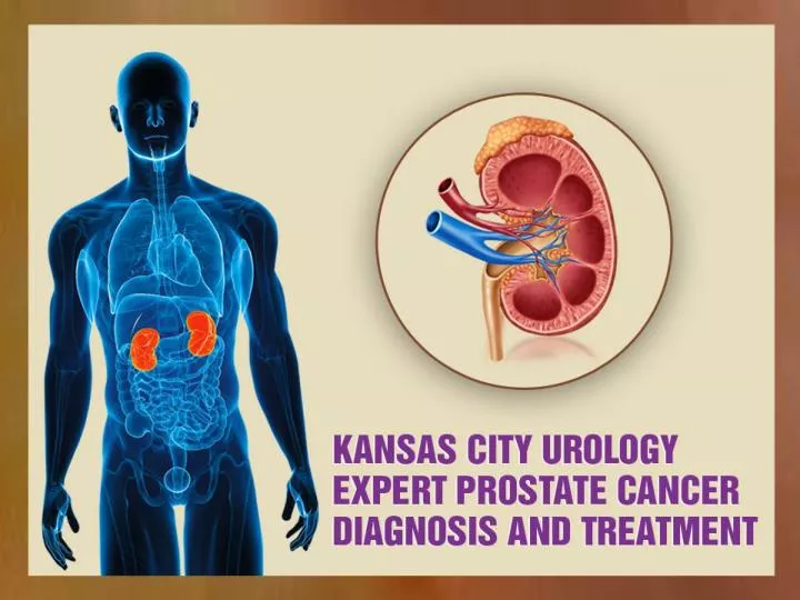 kansas city urology expert prostate cancer diagnosis and treatment