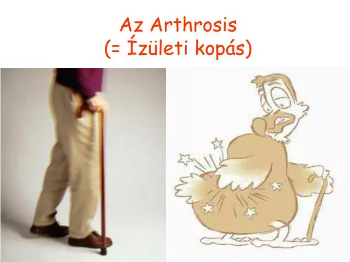 az arthrosis z leti kop s