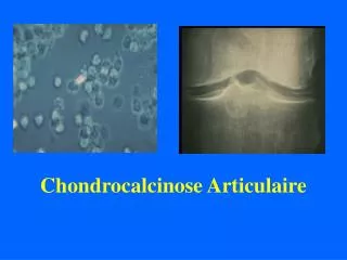 chondrocalcinose articulaire