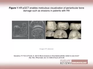 Geusens, P. P. M. &amp; Finzel, S. (2013) Bone erosions in rheumatoid arthritis: better to see more?