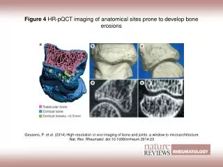 Figure 4 HR?pQCT imaging of anatomical sites prone to develop bone erosions