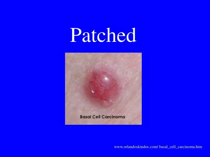 patched