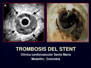 TROMBOSIS DEL STENT Clinica cardiovascular Santa Maria Medellin; Colombia