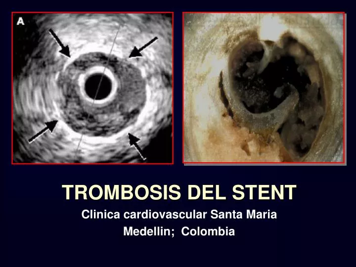 trombosis del stent clinica cardiovascular santa maria medellin colombia
