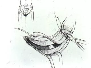 Cartoon of taking fascia
