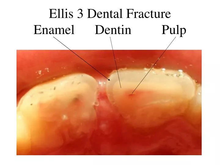 ellis 3 dental fracture enamel dentin pulp