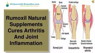 Rumoxil Natural Supplements Cures Arthritis And Joint Inflam