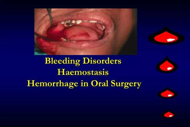bleeding disorders haemostasis hemorrhage in oral surgery