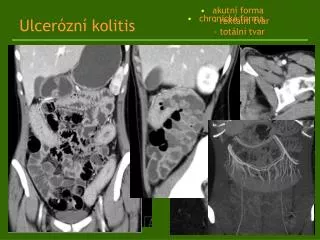 ulcer zn kolitis