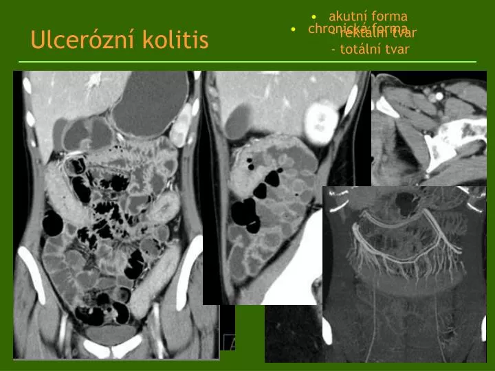 ulcer zn kolitis