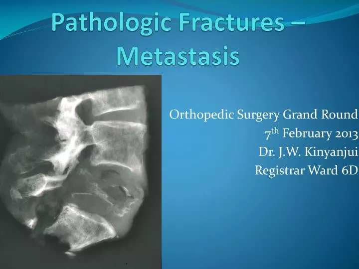 pathologic fractures metastasis