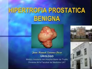hipertrofia prostatica benigna