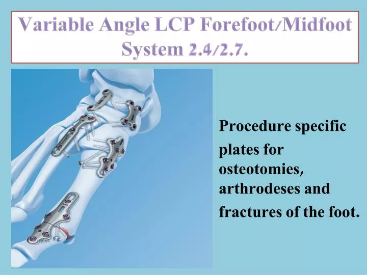 variable angle lcp forefoot midfoot system 2 4 2 7