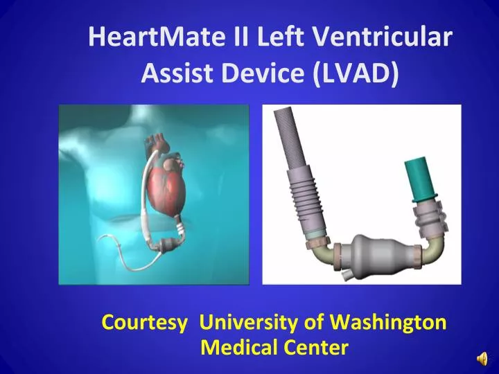 heartmate ii left ventricular assist device lvad