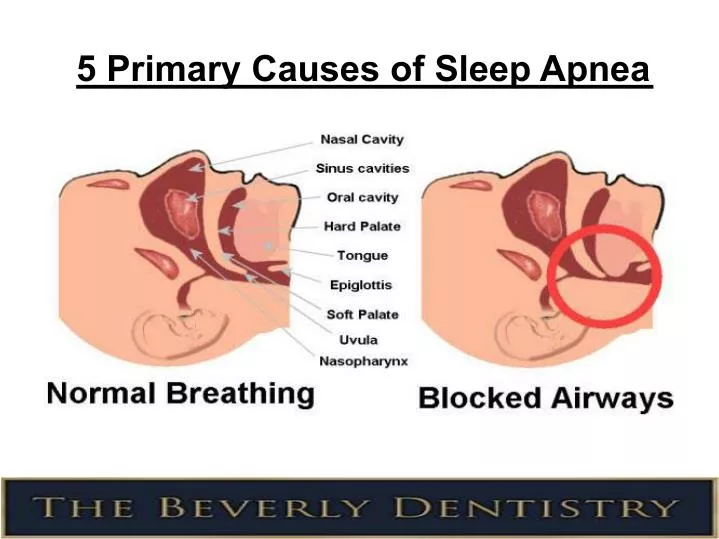 5 primary causes of sleep apnea