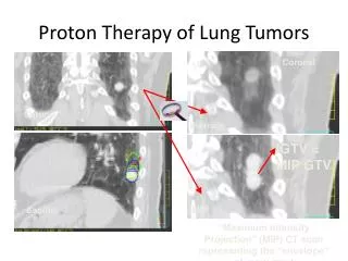 Proton Therapy of Lung Tumors