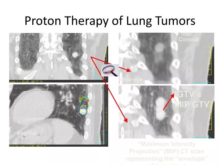proton therapy of lung tumors