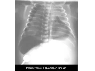 Pneumothorax &amp; pneumopericardium