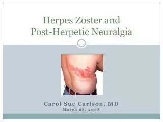 Herpes Zoster and Post-Herpetic Neuralgia