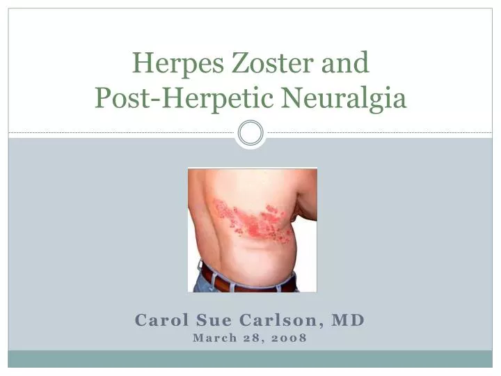 herpes zoster and post herpetic neuralgia