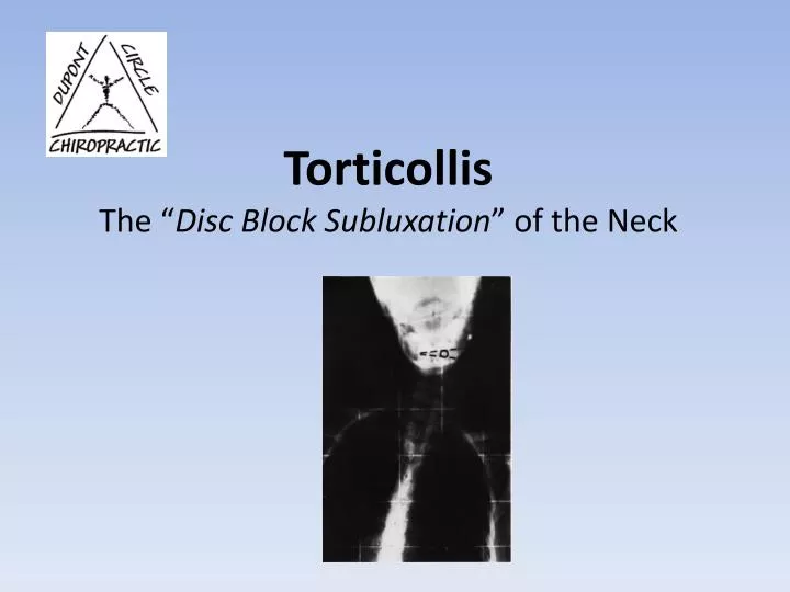 torticollis the disc block subluxation of the neck