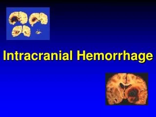 Intracranial Hemorrhage