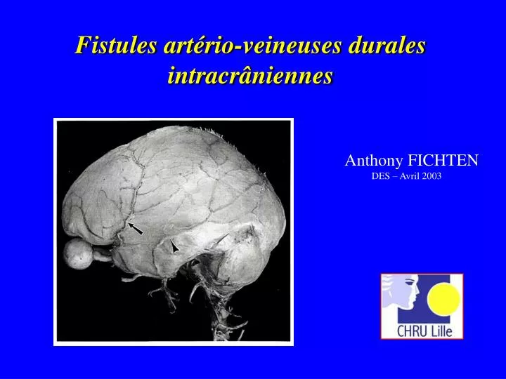 fistules art rio veineuses durales intracr niennes