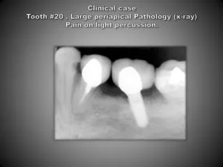 Clinical case Tooth #20 , Large periapical Pathology (x-ray) Pain on light percussion.