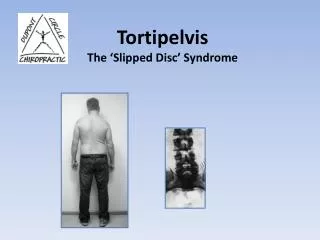 Tortipelvis The ‘Slipped Disc’ Syndrome