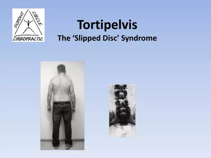 tortipelvis the slipped disc syndrome
