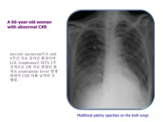 A 66-year-old woman with abnormal CXR