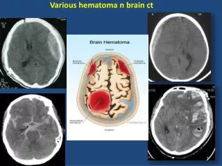 various hematoma n brain ct