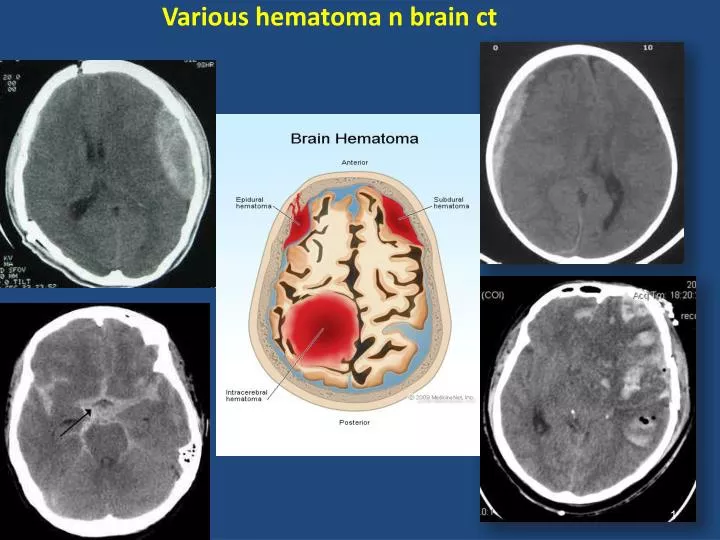 various hematoma n brain ct