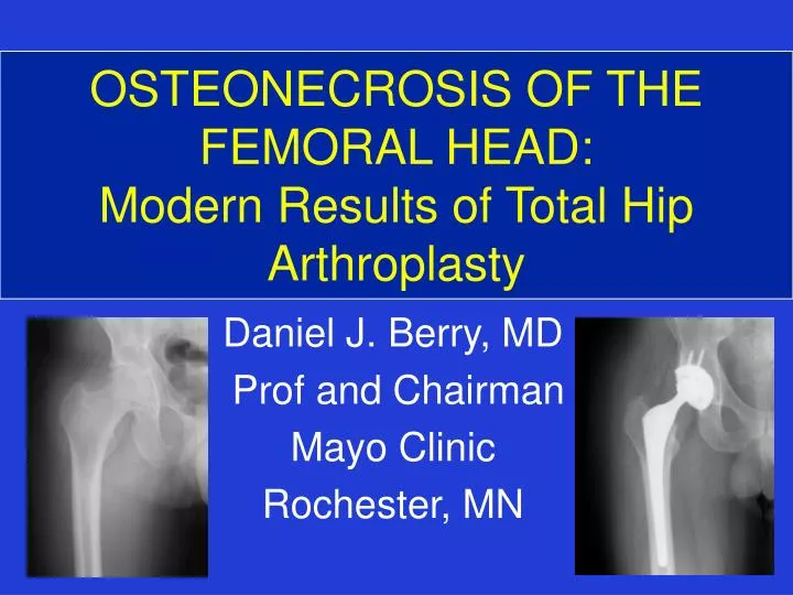 osteonecrosis of the femoral head modern results of total hip arthroplasty
