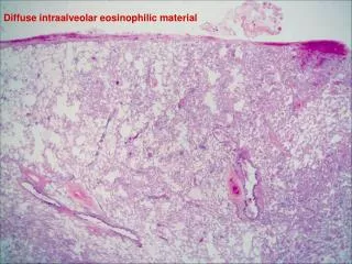 Diffuse intraalveolar eosinophilic material